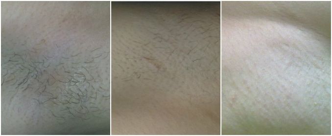 Pažasties plaukelių šalinimas. Nuotraukos prieš procedūrą, jos metu ir po