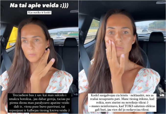 Ieva Swan patyrė dalies veido paralyžių: kaltos - botokso injekcijos
